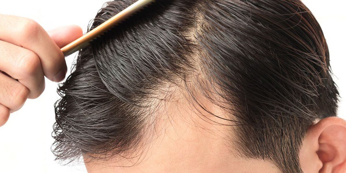 Finasteride Vs Minoxidil Which Men S Hair Loss Treatment Is Best